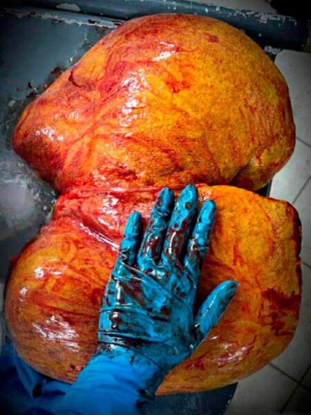 تاثیر وحشتناک مشروبات الکلی در بدن زن روسی خبرساز شد