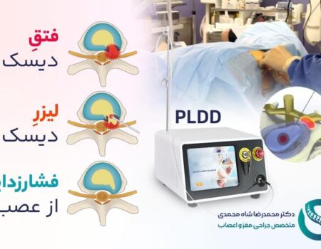 نحوه عمل لیزر دیسک کمر - دکتر محمدرضا شاه محمدی