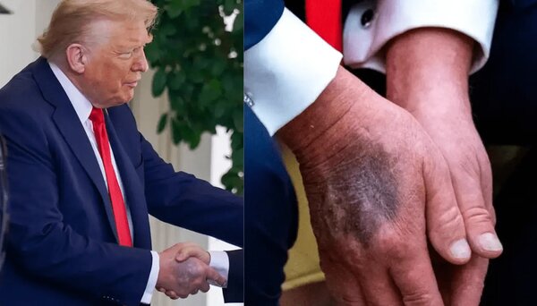 بیماری ترامپ| کبودی‌ها و واکنش پزشکان