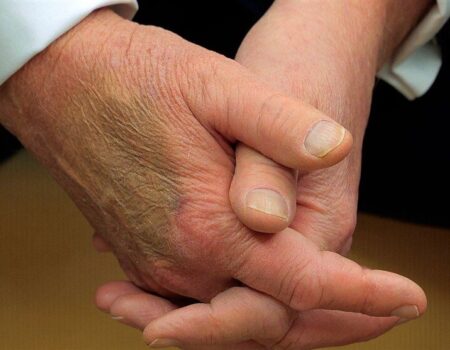 بیماری ترامپ چیست؟ | تلاش دوباره ترامپ برای پنهان کردن کبودی دست راست