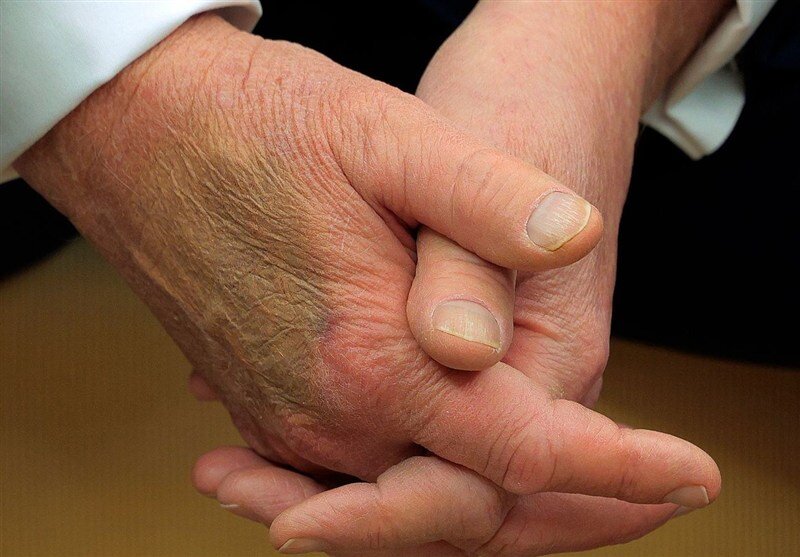 بیماری ترامپ چیست؟ | تلاش دوباره ترامپ برای پنهان کردن کبودی دست راست بیماری ترامپ چیست؟ | تلاش دوباره ترامپ برای پنهان کردن کبودی دست راست